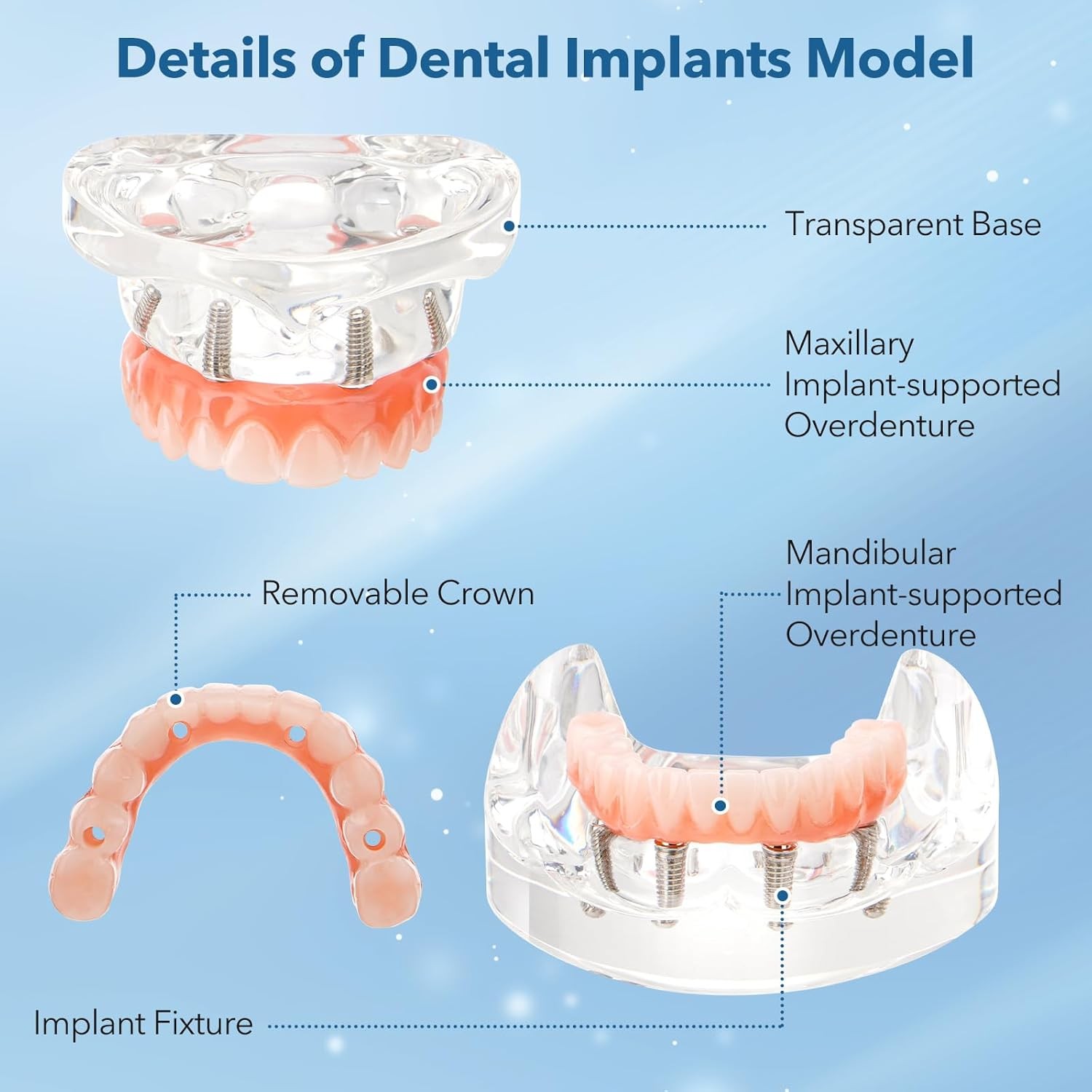 New Dental Implant Model All-on-4 All-on-6 Overdenture U/L Jaw 4/6 Screws Clear