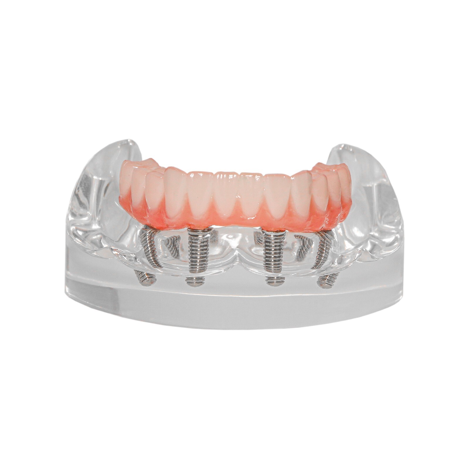 All-on-4/6 Dental Implant Model Upper/Lower Jaw Removable Screws Transparent