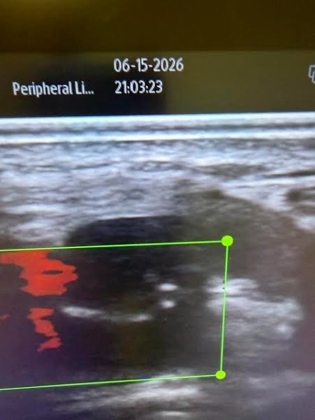 MINDRAY TE 7 ultrasound with two probes