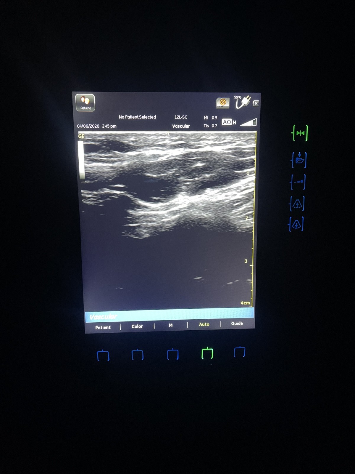GE VENUE 40 Vascular Portable Ultrasound W/ 12L-SC Probe and docking station