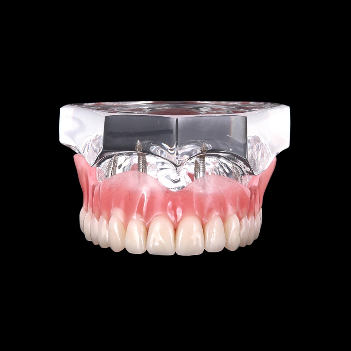 4 Implants Upper Lower Implant Teeth Model Dental Overdenture Restoration Model