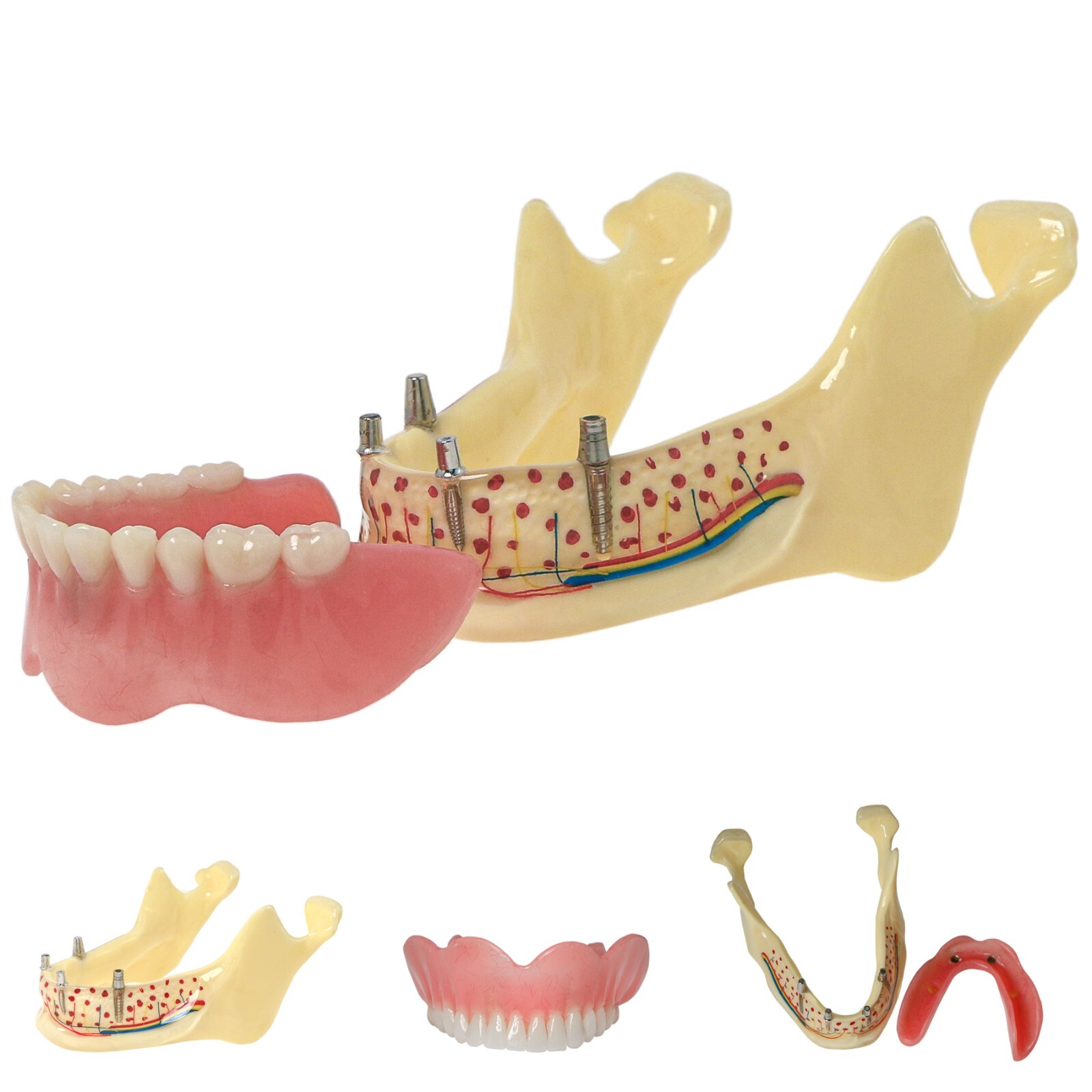 Dental Implant Model Upper Lower Jaw Demo All on 4/6 Overdenture treatment model
