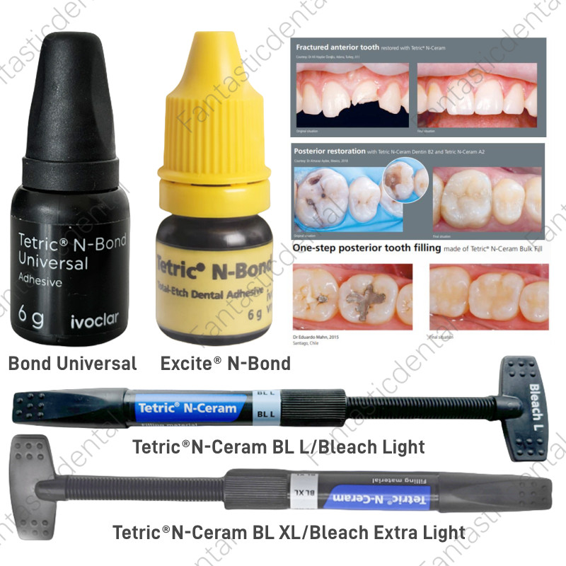 Dental TetricN Ceram Universal Bond BLXL BLL Composite Resin Bleach Light Veneer