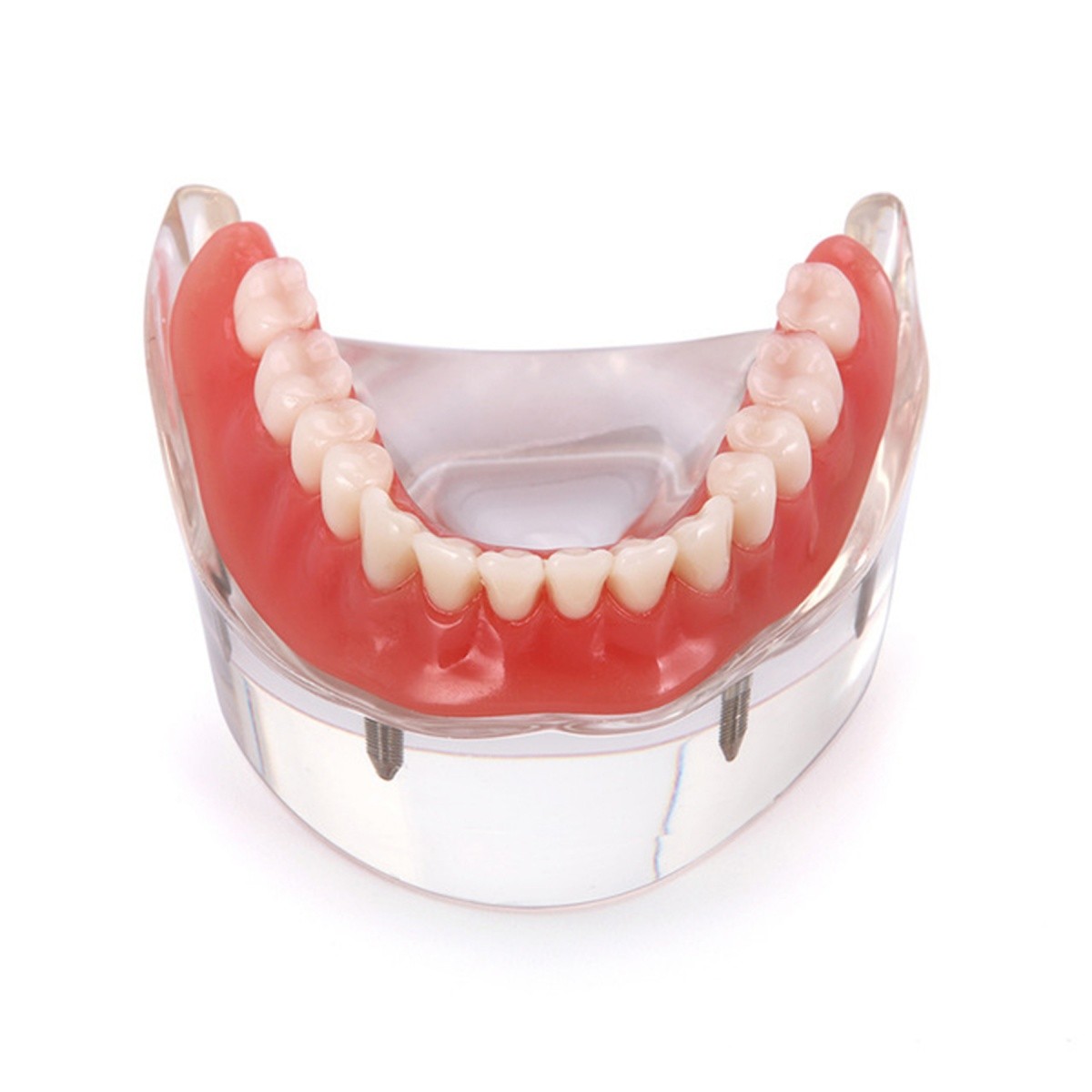 4 Implants Upper Lower Implant Teeth Model Dental Overdenture Restoration Model