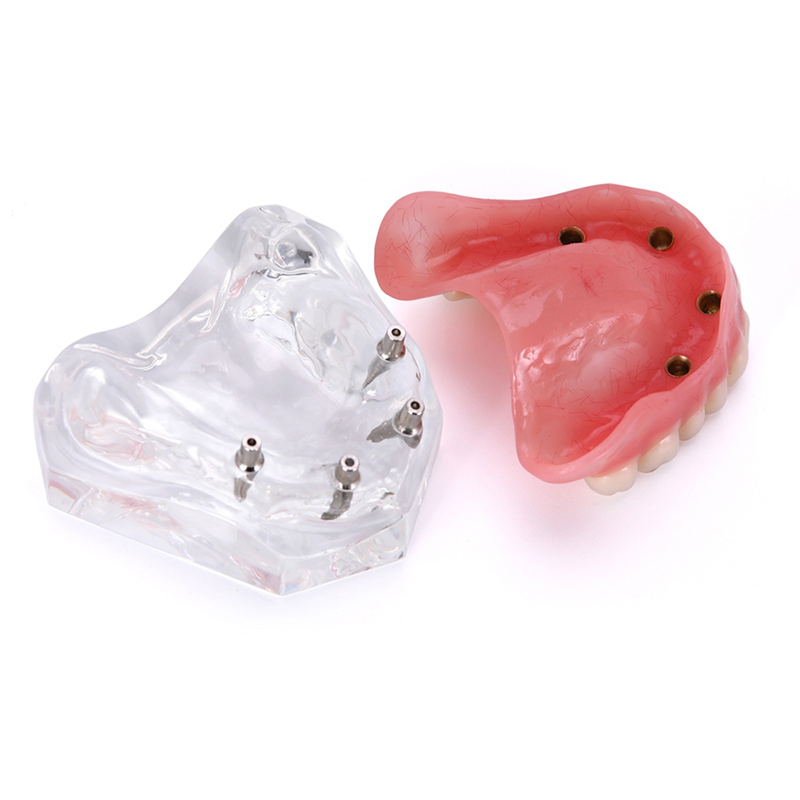 US Dental Implant Teeth Model Overdenture Restoration With4 Implants Upper Lower