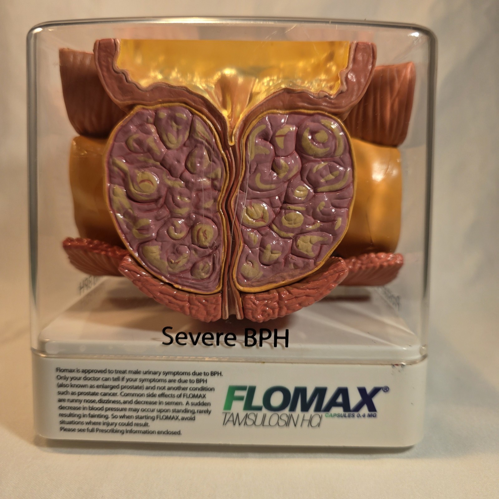 Human Prostate Anatomical Display Model Set Normal Mild/Severe BPH/Cancer