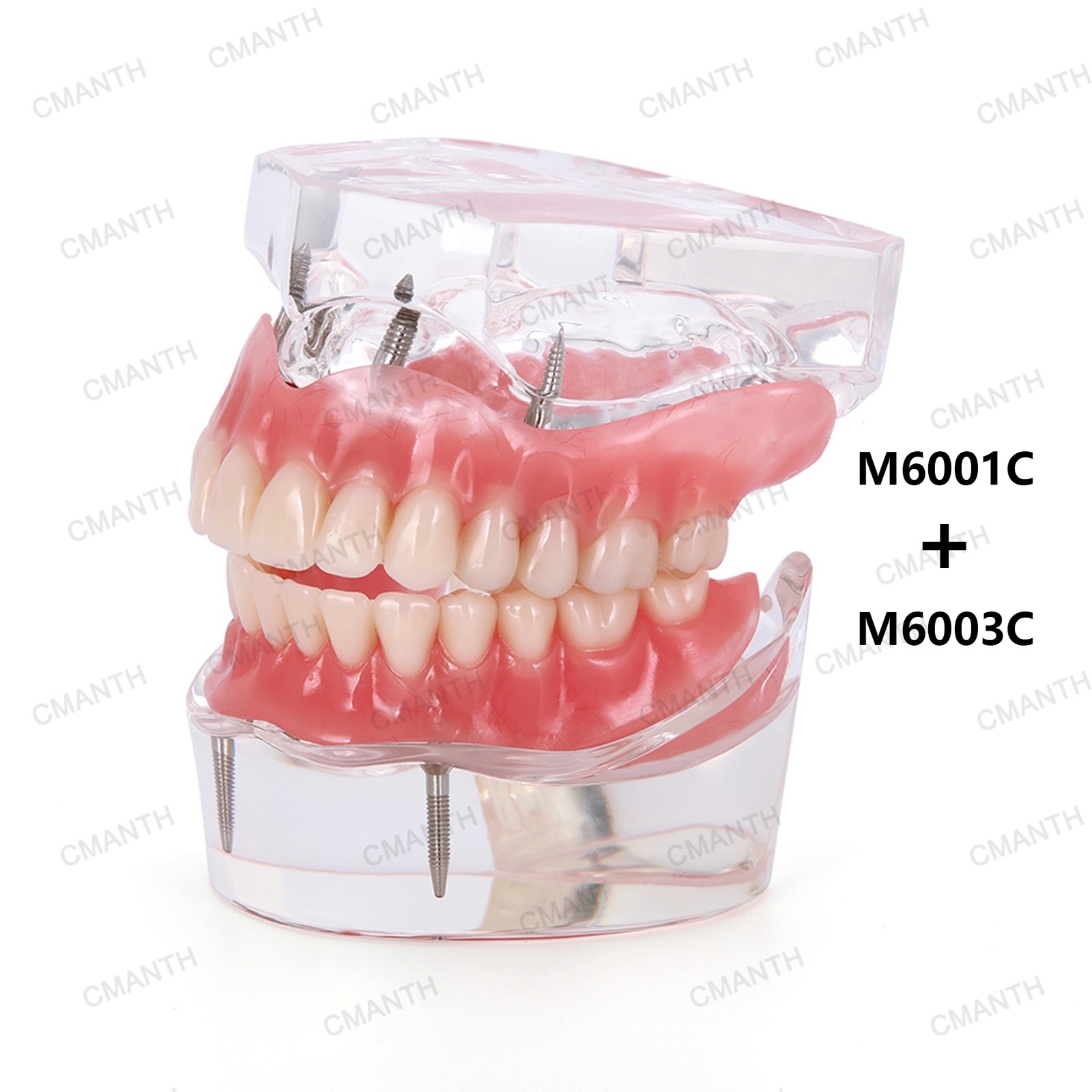 US Dental Implant Teeth Model Overdenture Restoration With4 Implants Upper Lower