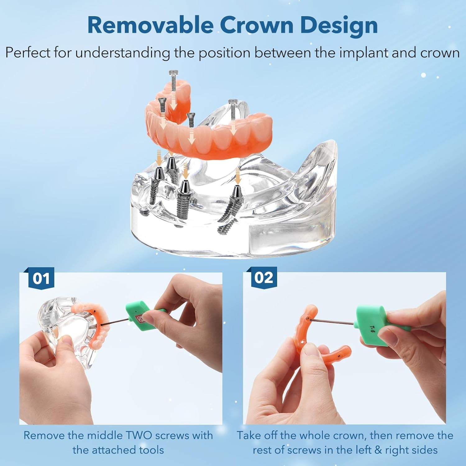 New Dental Implant Model All-on-4 All-on-6 Overdenture U/L Jaw 4/6 Screws Clear