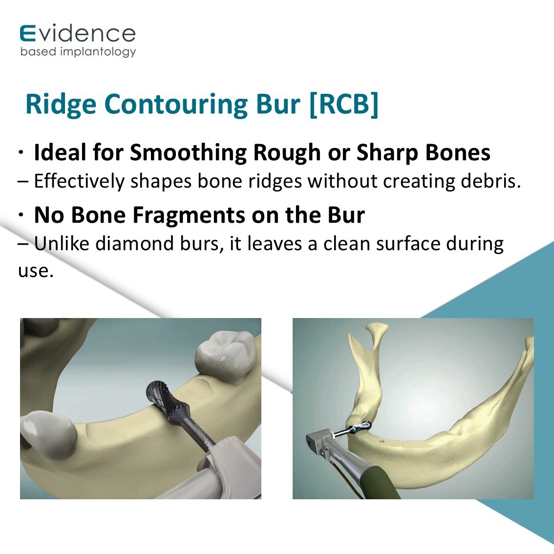 Evidence Implant Ridge Contouring Bur [RCB]