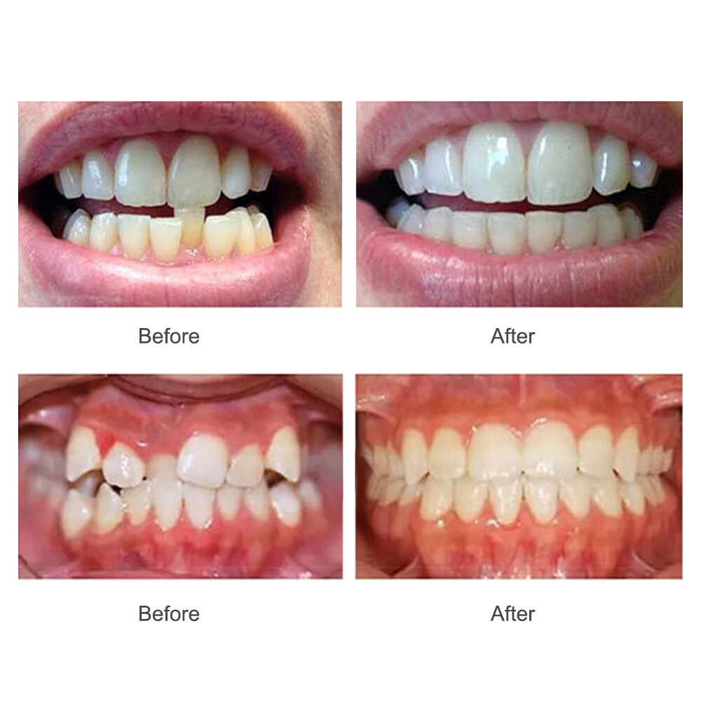 3-Stage Adult Teeth Aligners Orthodontic Braces Trainer for Dental Alignment Hot