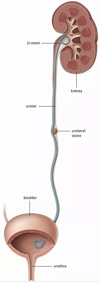 Double J stent with pusher urology 6Fr 26cm 100 pieces DJ Stent FREE SHIPPING
