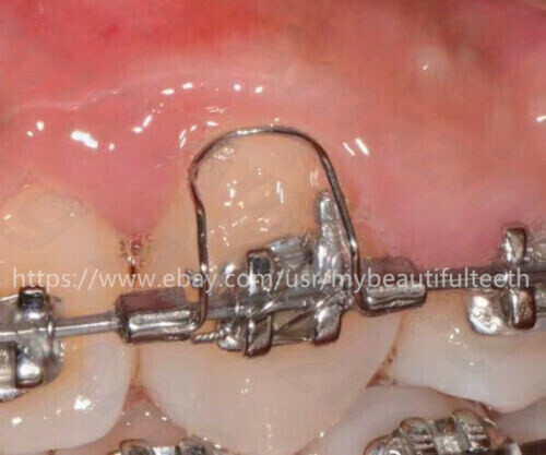 Dental Orthodontic Torquing Torque Spring Rectangular wire Single Anterior Teeth