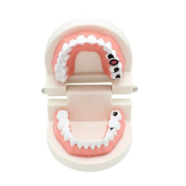 5 Pcs Dental High Quality Material Decay Standard Teeth Teach Adult Caries Model