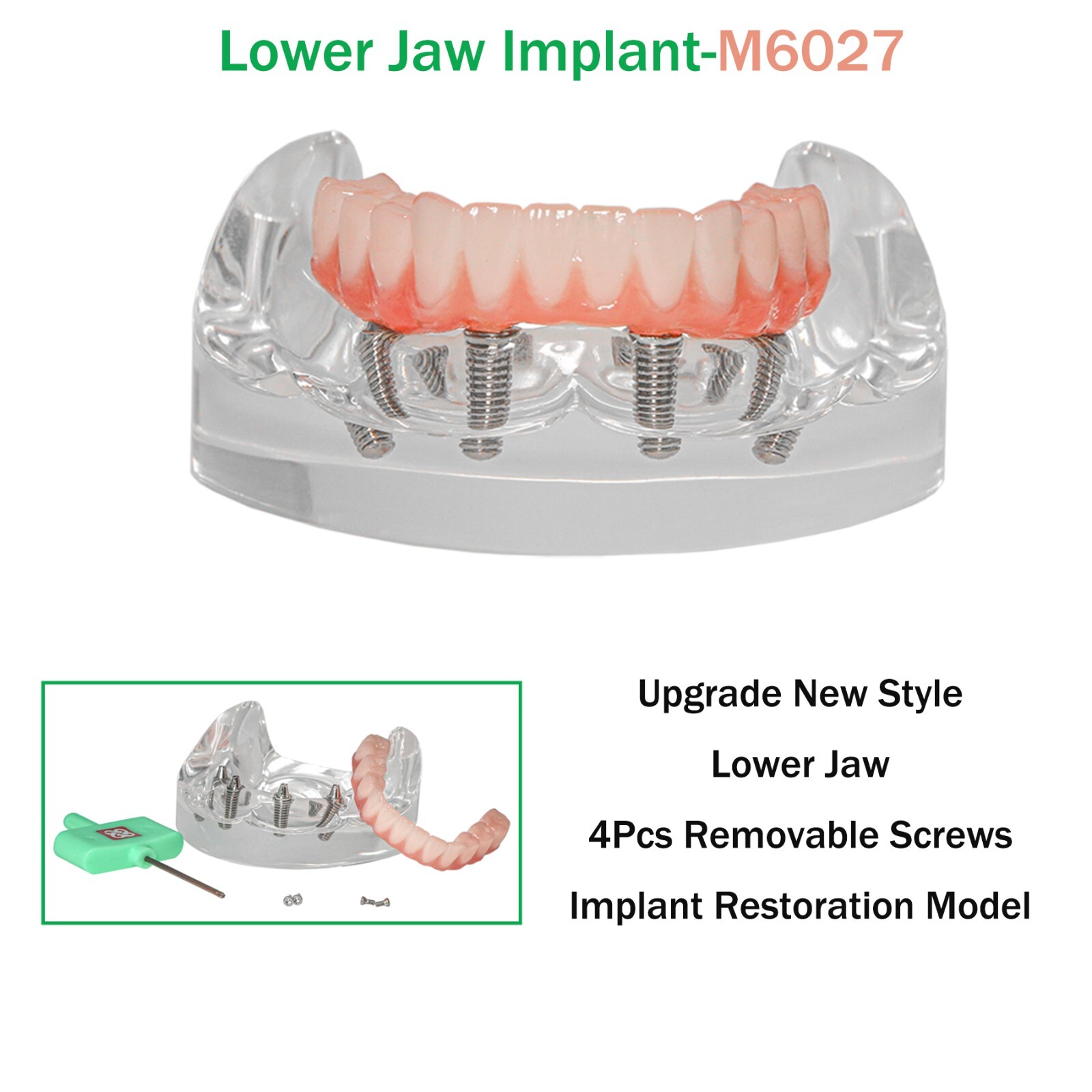 All-on-4/6 Screws Restoration Overdenture Dental Implant Model Upper/Lower Jaw