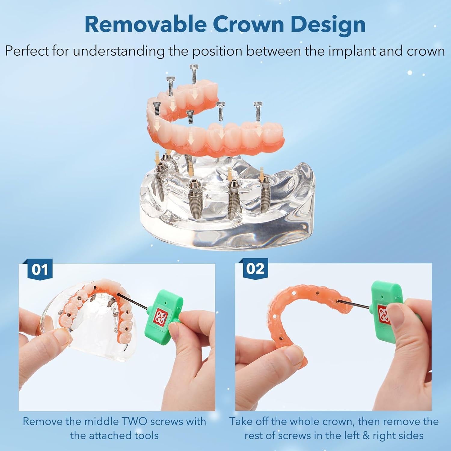New Dental Implant Model All-on-4 All-on-6 Overdenture U/L Jaw 4/6 Screws Clear