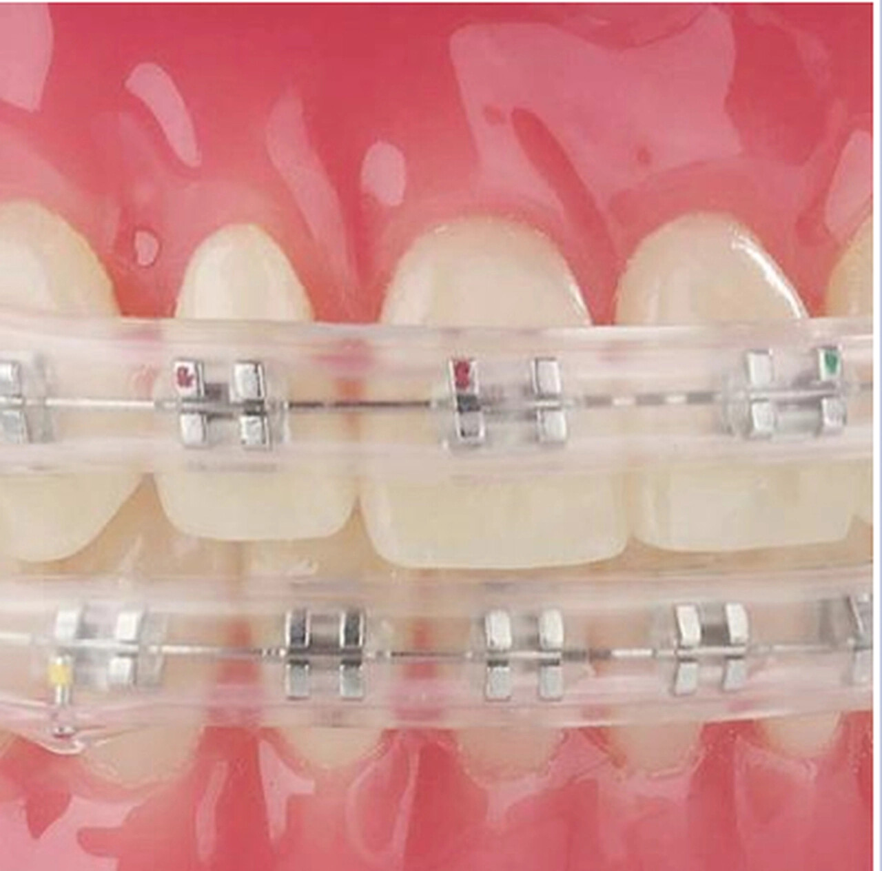 J&J Ortho™ Dental Orthodontic Comfort Protective Lip Bumper Protector for Braces