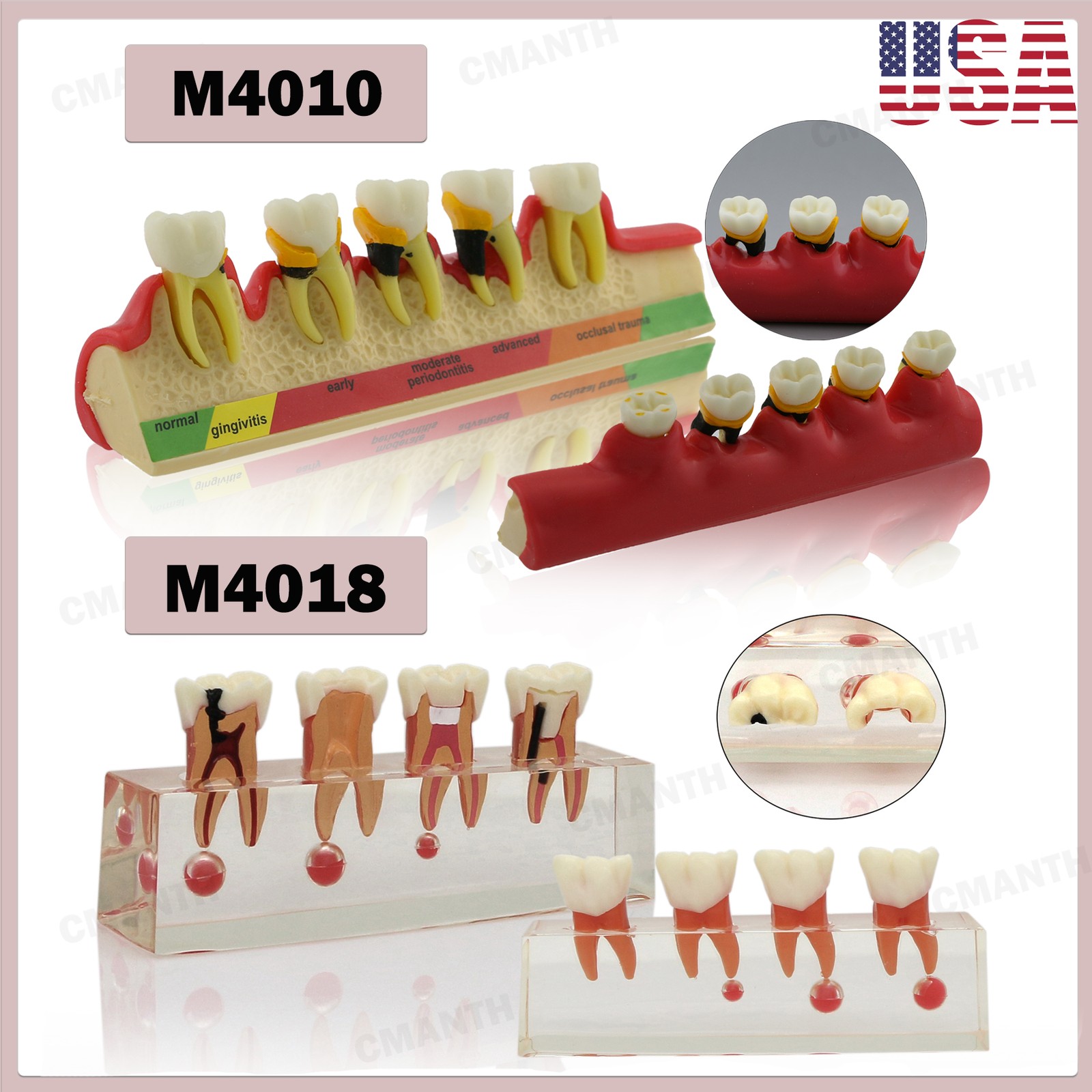 US Dental Model Upper Lower Jaw 4 Overdenture Practice Implant Typodont Demo