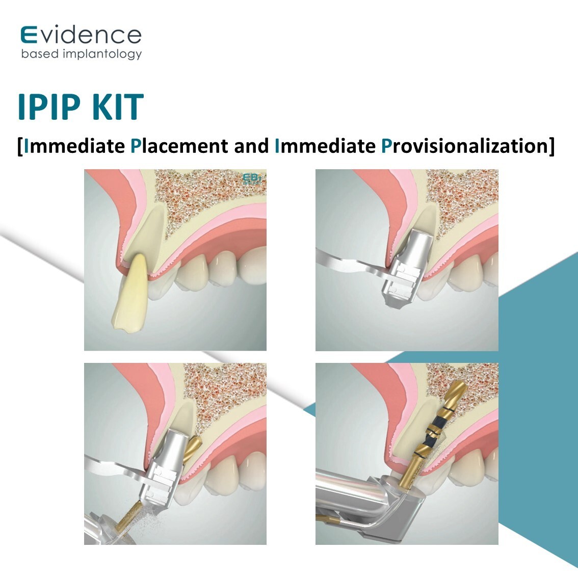 Evidence Implant IPIP Kit