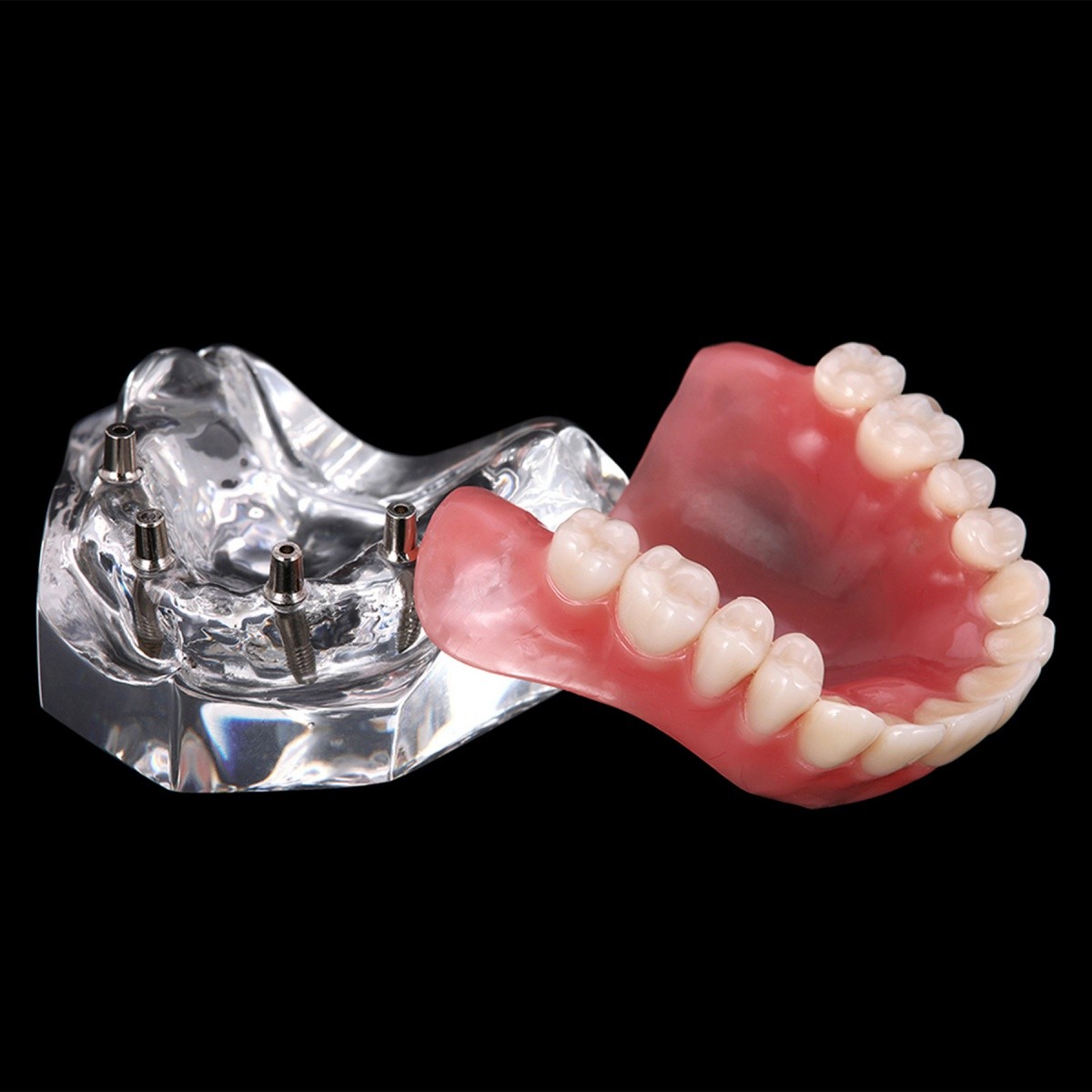 4 Implants Upper Lower Implant Teeth Model Dental Overdenture Restoration Model