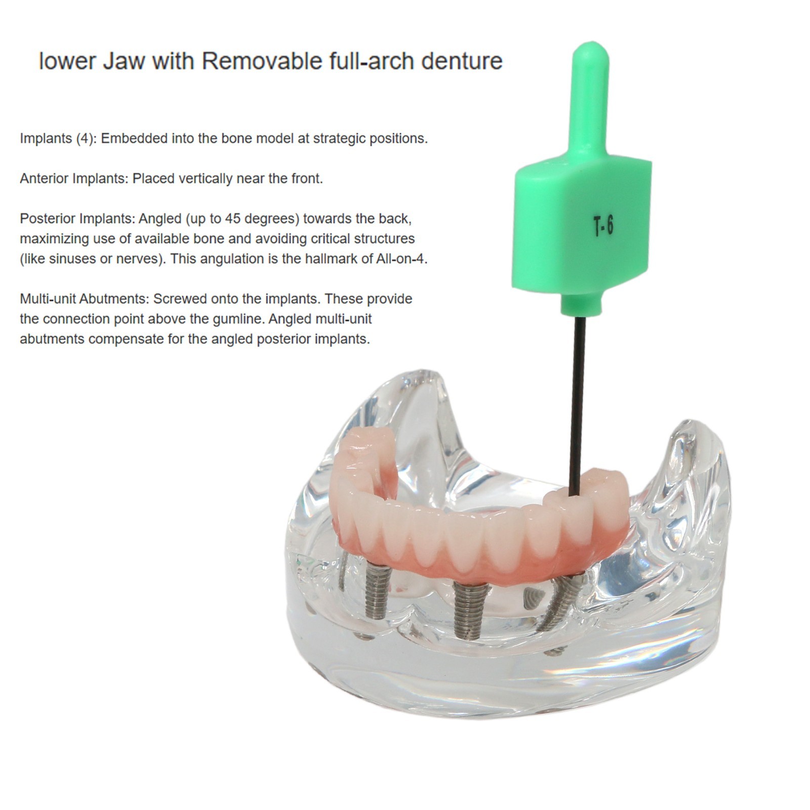 All-On-4 Dental Implant System Overdenture Treatment Teeth Model U/L Jaw W/screw