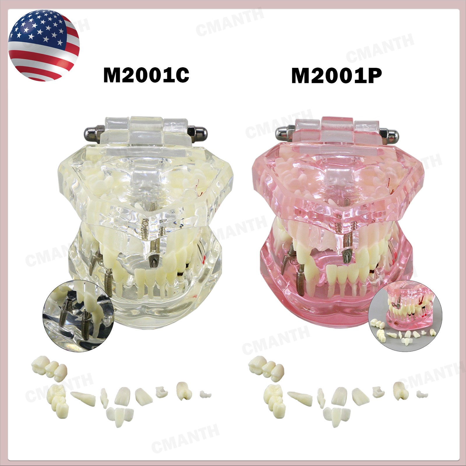 US Dental Model Upper Lower Jaw 4 Overdenture Practice Implant Typodont Demo