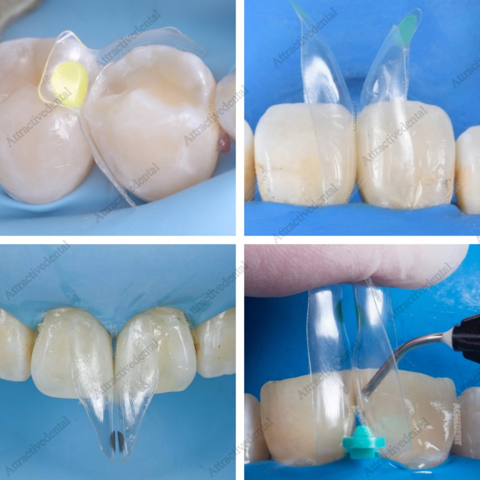 USA Clear Matrix Dental Anterior Posterior Transparent BT Matrices Fit BioClear