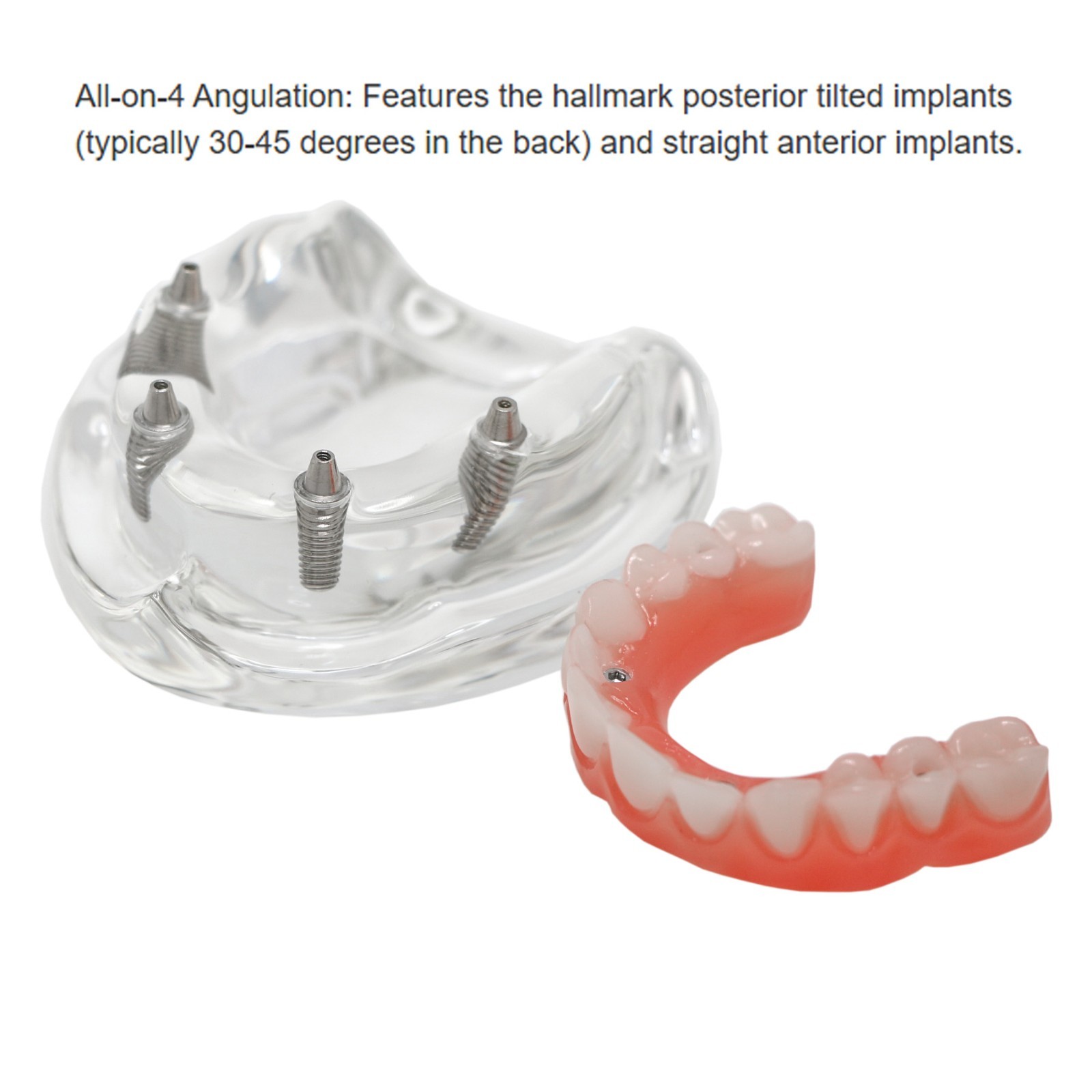All-On-4 Dental Implant System Overdenture Treatment Teeth Model U/L Jaw W/screw