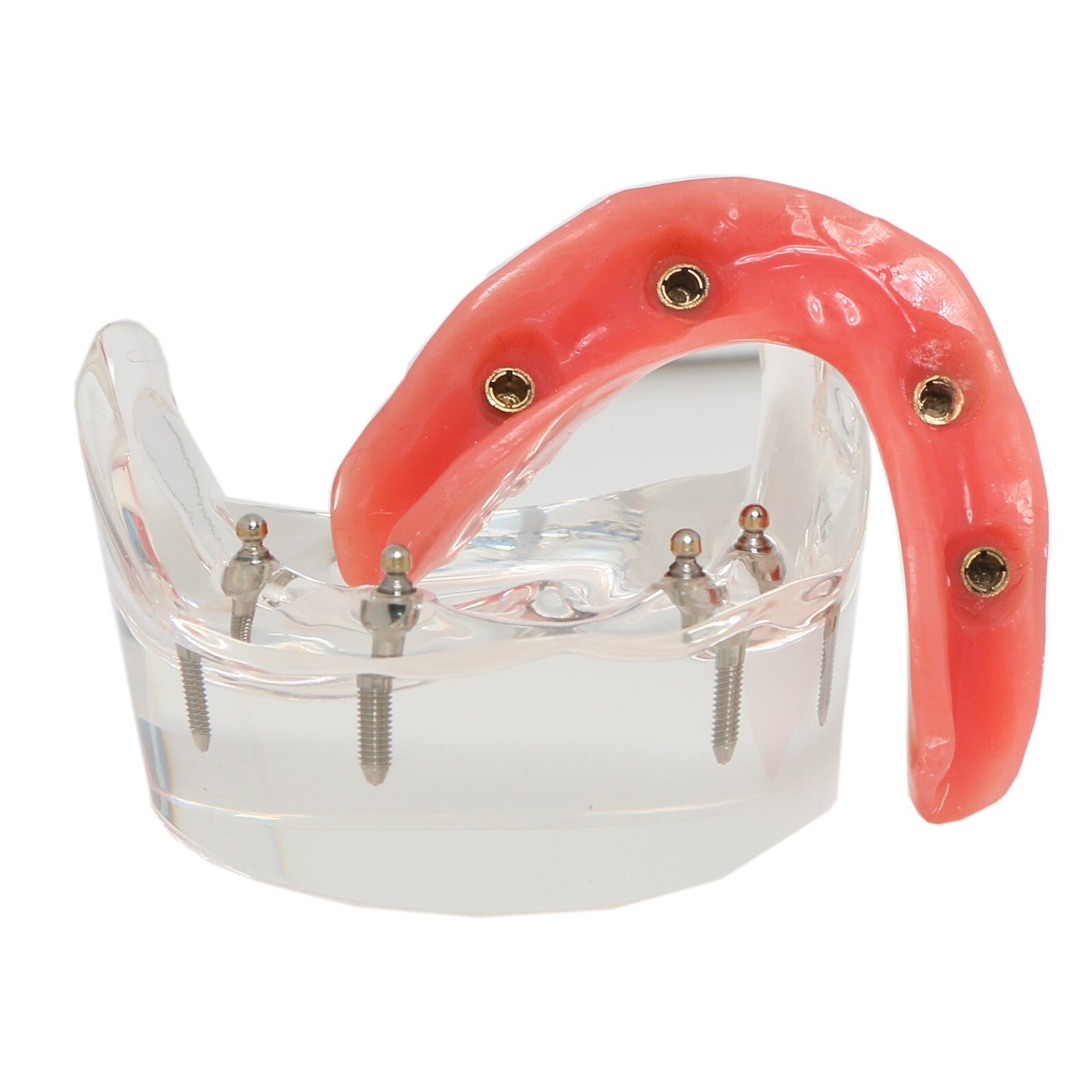 Dental Implant Model Upper Lower Jaw Demo All on 4/6 Overdenture treatment model
