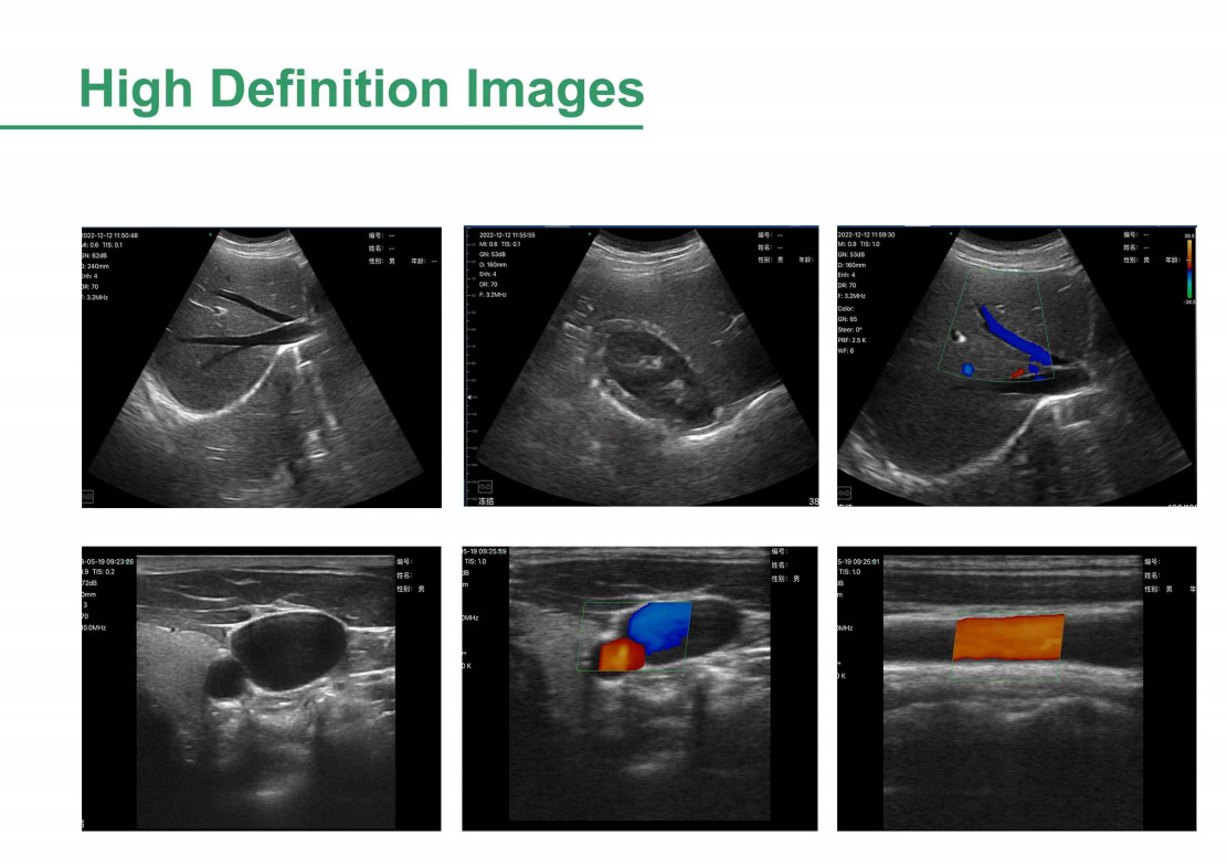 Handheld Wireless Doppler Ultrasound With Interchangeable Probes(To be selected)