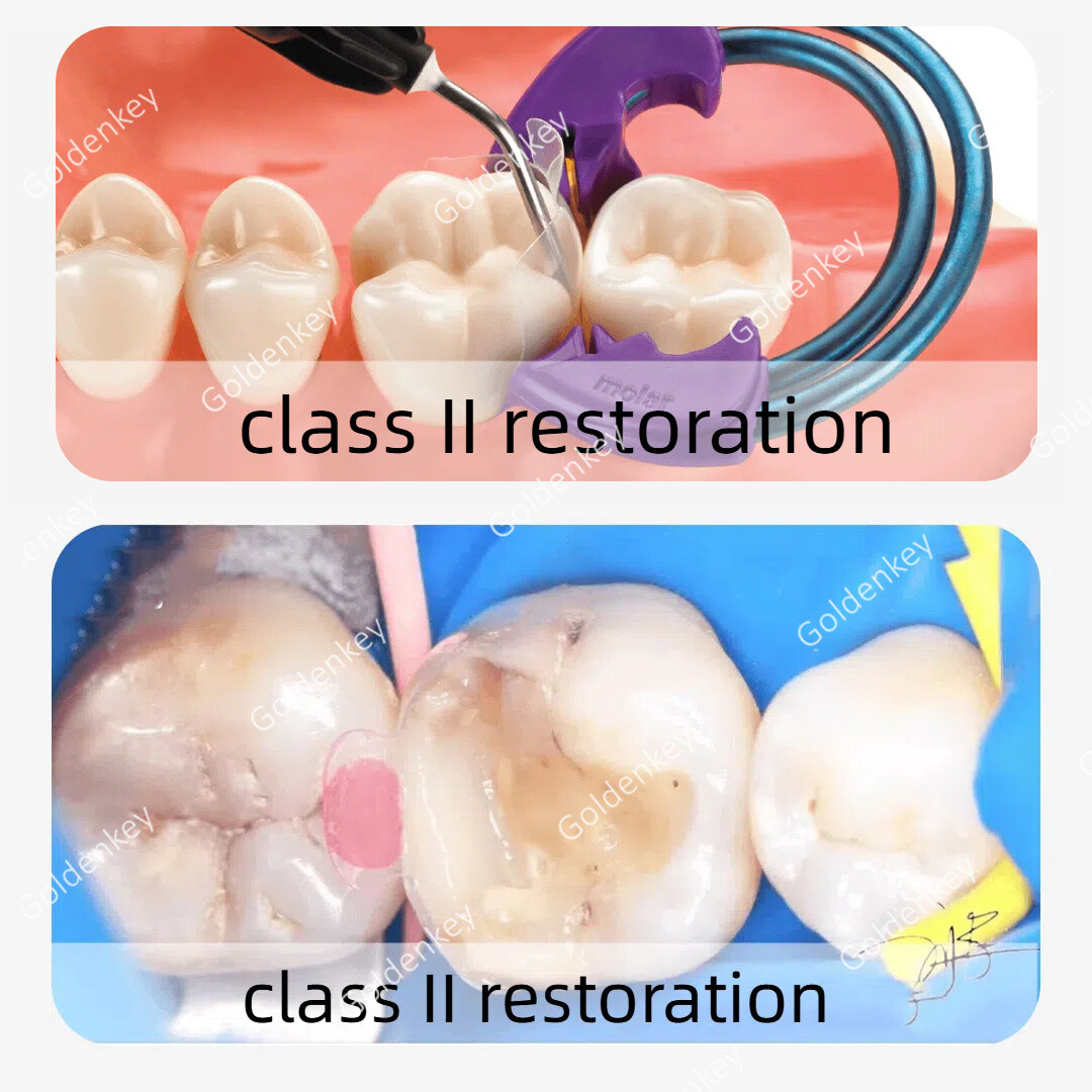Dental Clear Matrix Posterior Transparent BT Matrices Fits Bioclear 4.5/5.5/6.5