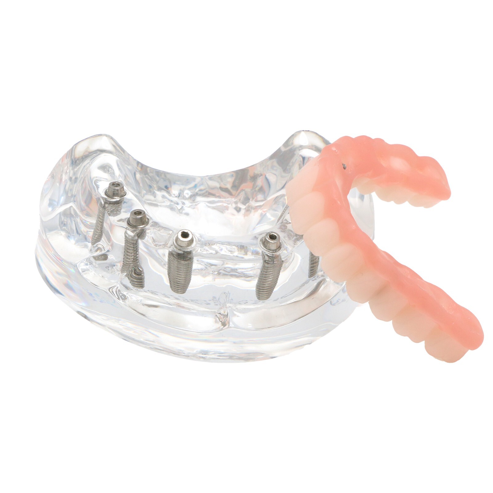 All-on-4/6 Screws Restoration Overdenture Dental Implant Model Upper/Lower Jaw