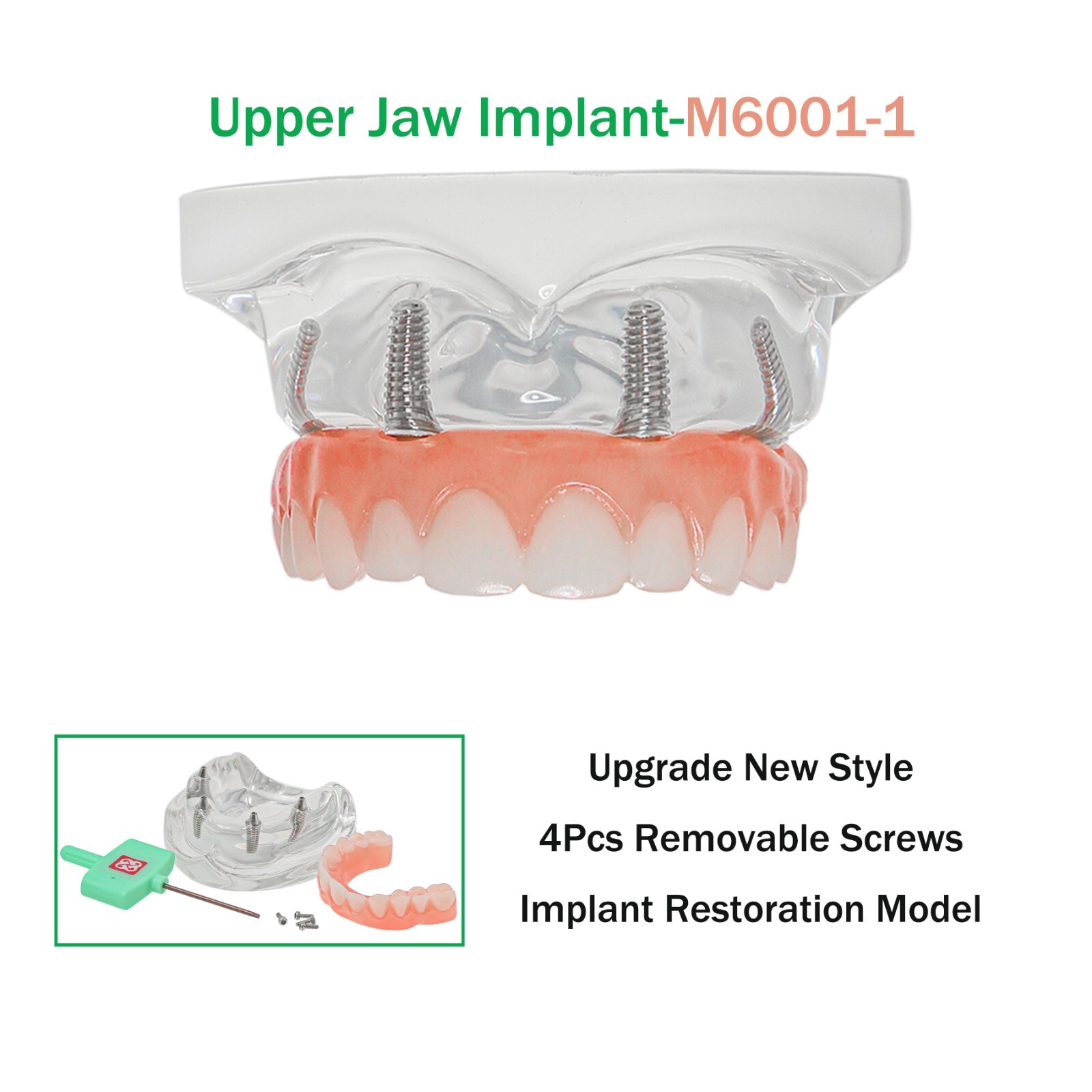 All-on-4/6 Screws Restoration Overdenture Dental Implant Model Upper/Lower Jaw
