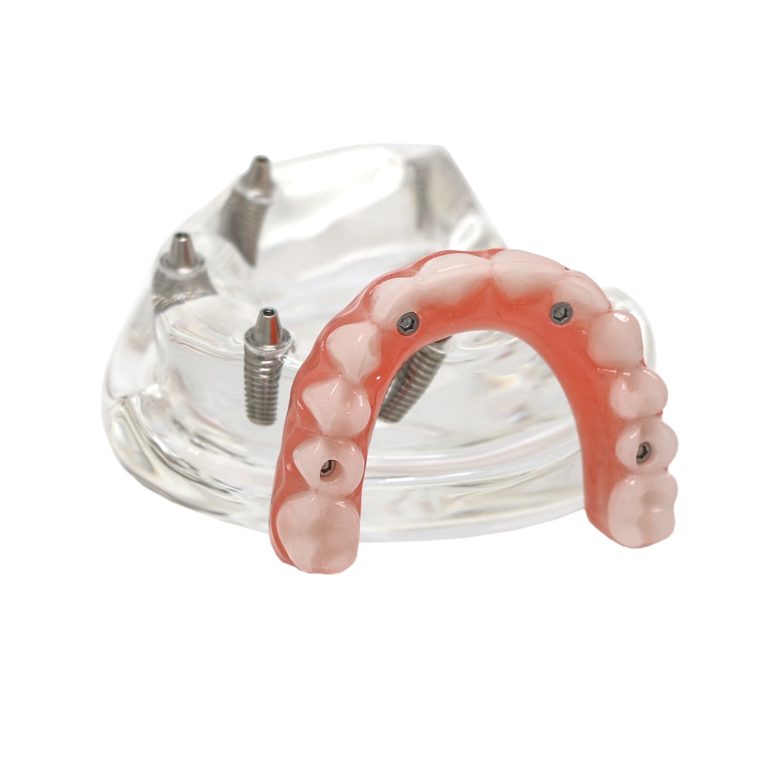 Dental All-on-4 Overdenture Implant Model, Upper/Lower Jaw-Clear,With 4 Screw