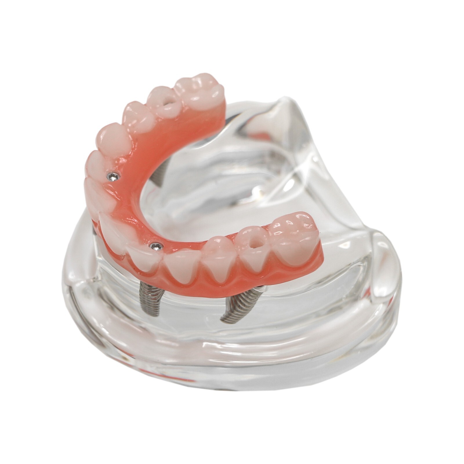 Dental All-on-4 Overdenture Implant Model, Upper/Lower Jaw-Clear,With 4 Screw