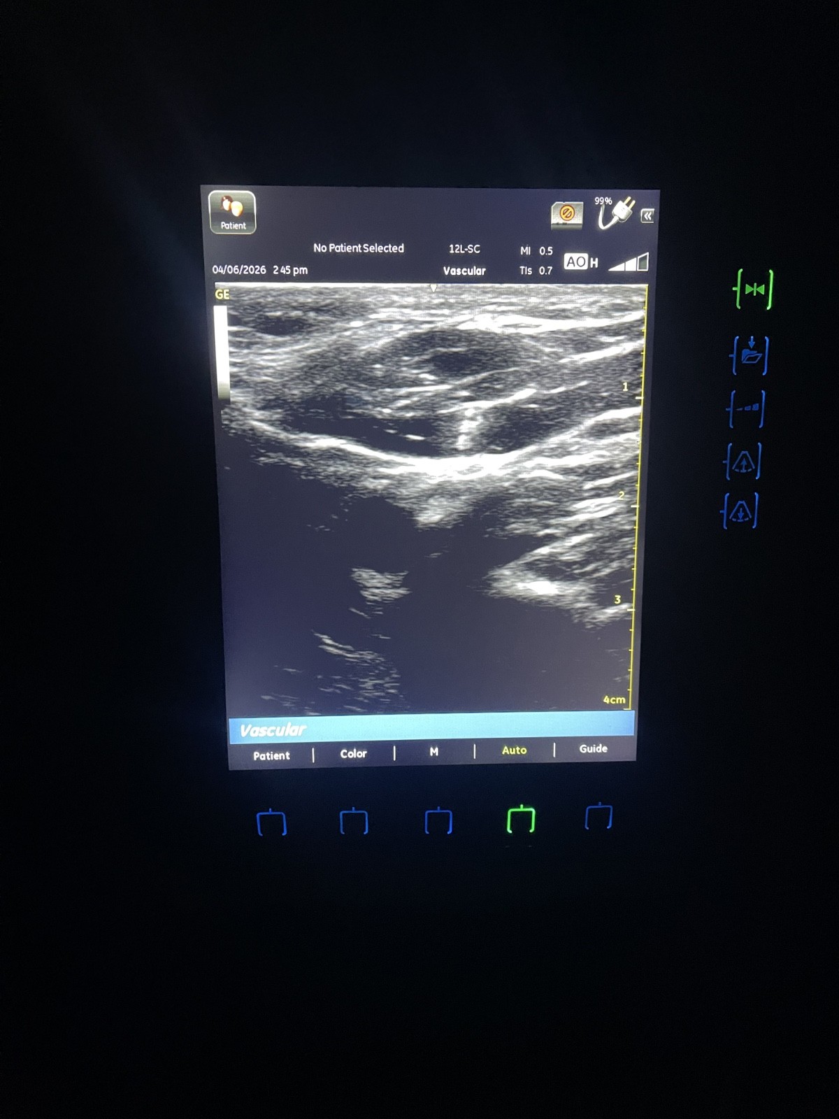 GE VENUE 40 Vascular Portable Ultrasound W/ 12L-SC Probe and docking station