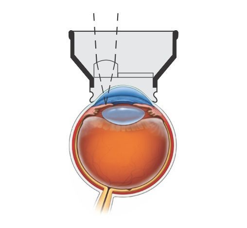 New Precision YAG Iridectomy Lens For Ophthalmology & Optometry Free Ship 100%