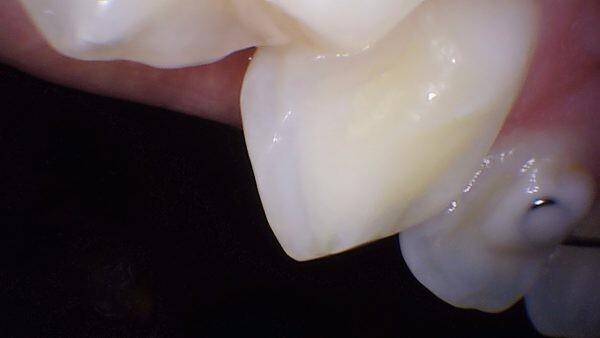 PerfectCam HD Intraoral Camera, USB Dental Camera, Free Capture Button Software.