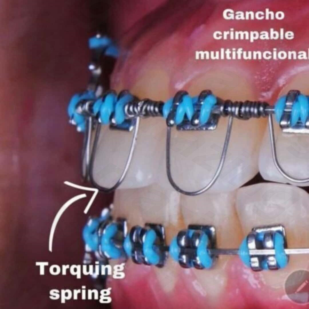 Dental Orthodontic Torquing Torque Spring Rectangular wire Single Anterior Teeth