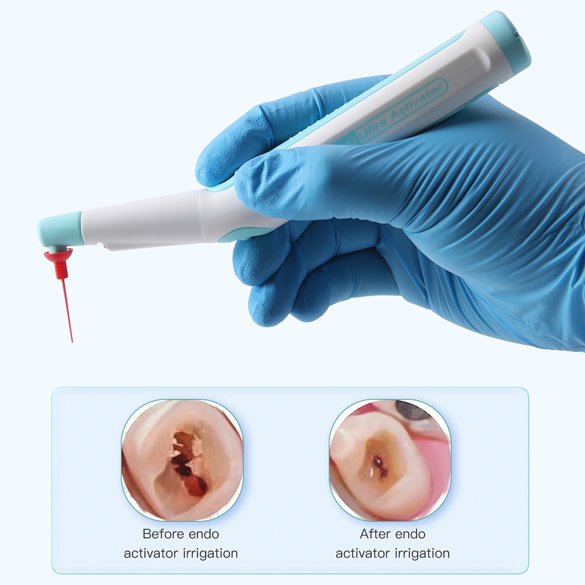 Dental Endodontic LED Activator Sonic Endo Ultra Irrigator Root Canal 150 Tips