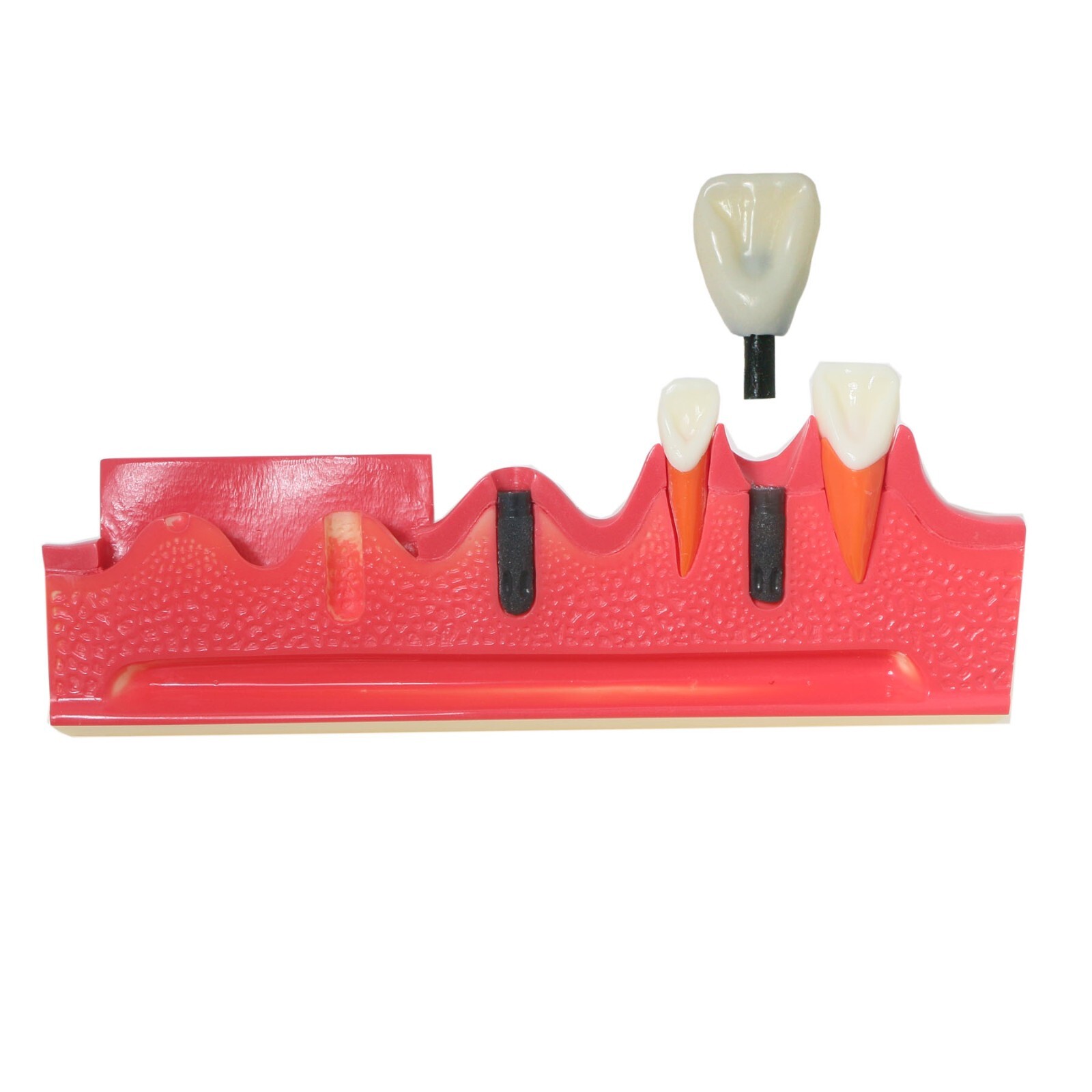 Dental Implant Model Upper Lower Jaw Demo All on 4/6 Overdenture treatment model