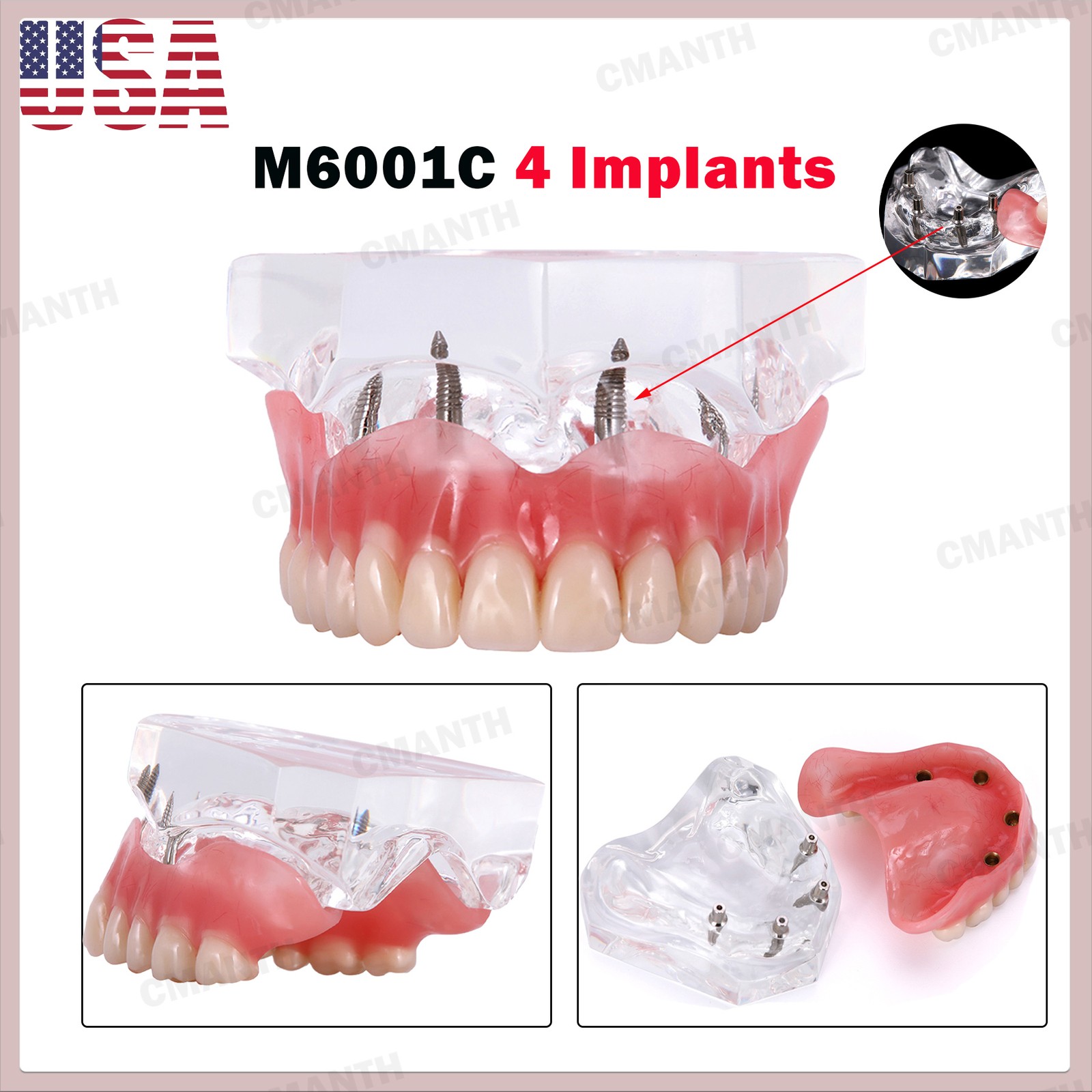 US Dental Model Upper Lower Jaw 4 Overdenture Practice Implant Typodont Demo