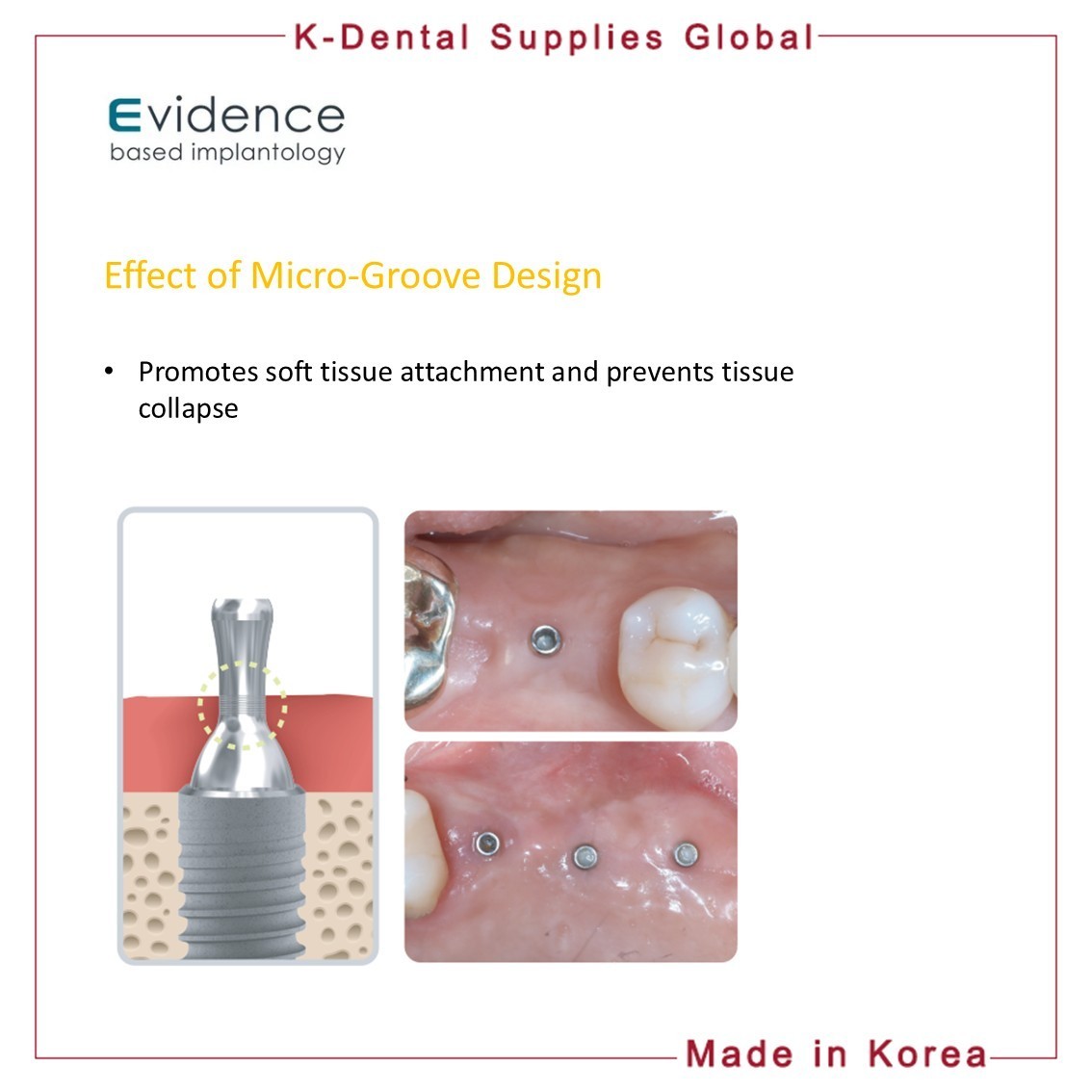 Evidence GBR Healing Pin Abutment
