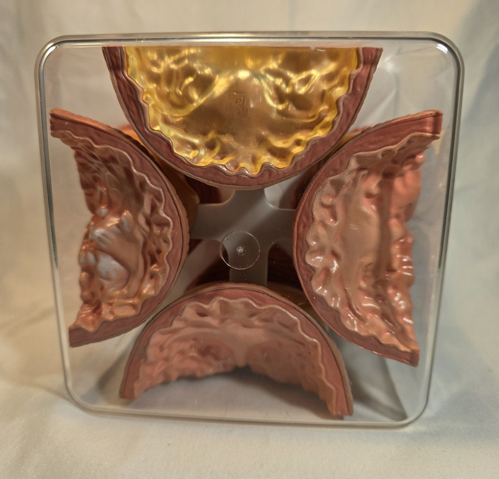 Human Prostate Anatomical Display Model Set Normal Mild/Severe BPH/Cancer
