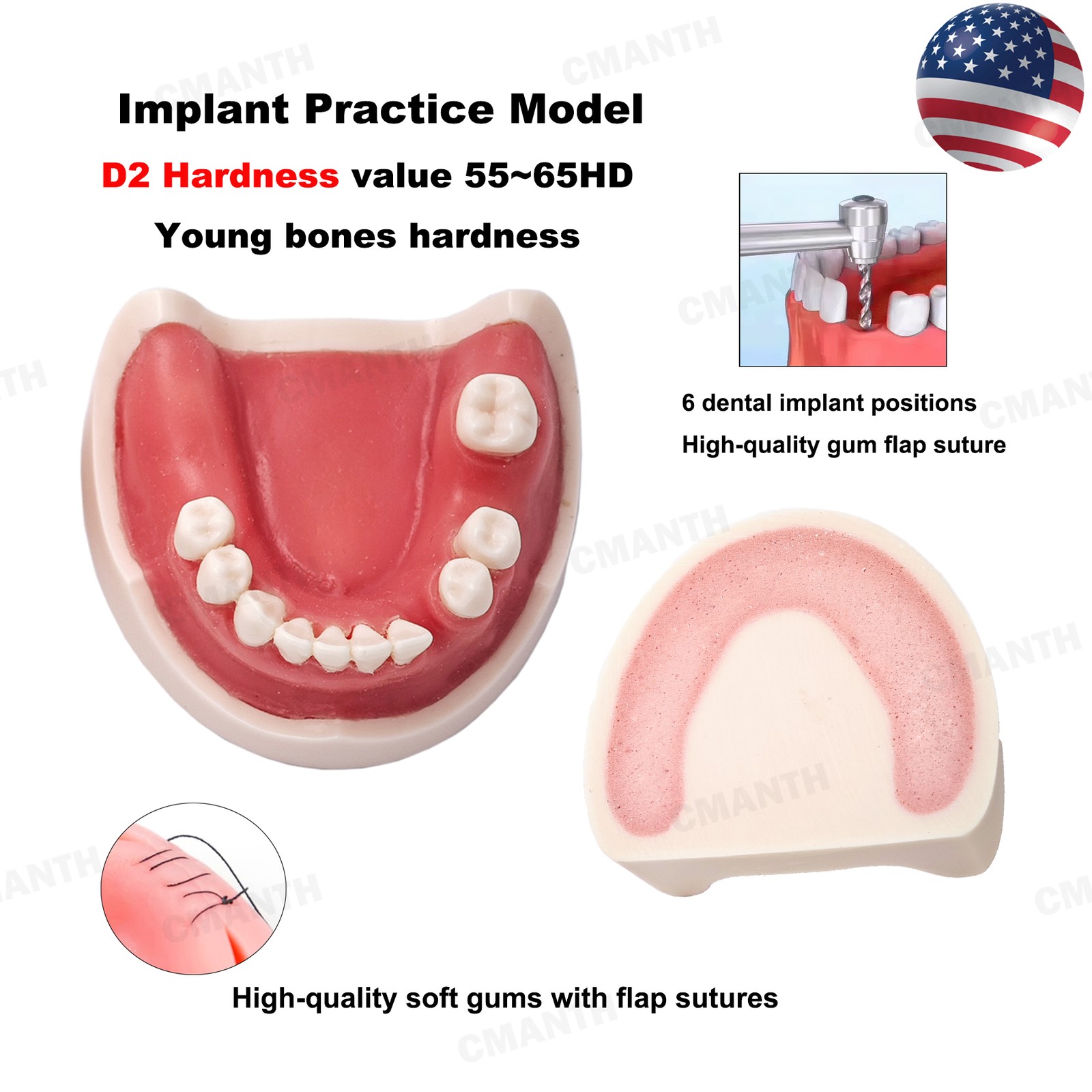 US Dental Model Upper Lower Jaw 4 Overdenture Practice Implant Typodont Demo