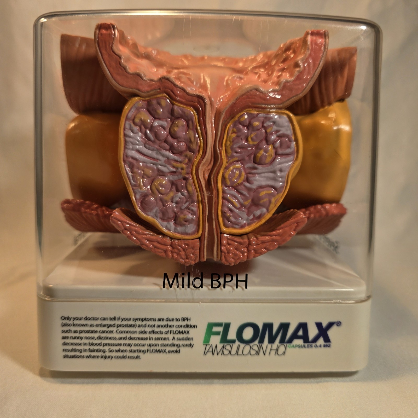 Human Prostate Anatomical Display Model Set Normal Mild/Severe BPH/Cancer