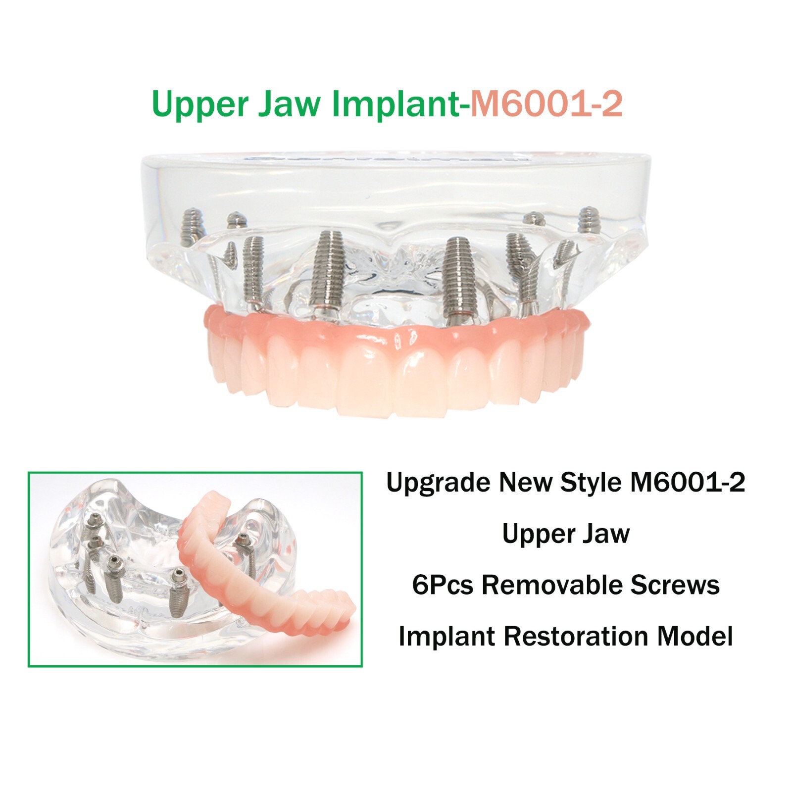 All-on-4/6 Screws Restoration Overdenture Dental Implant Model Upper/Lower Jaw