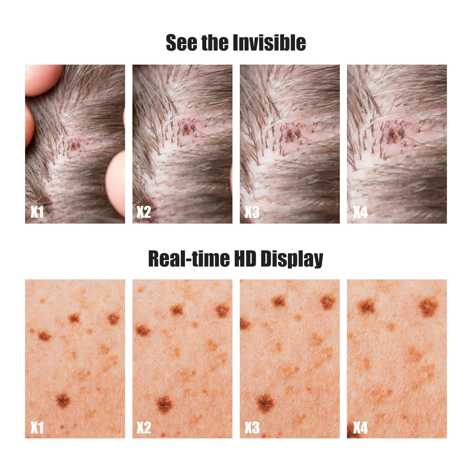 Handheld Dermatoscope, 500X Magnification Skin & Scalp Analyzer for Scalp/Hair