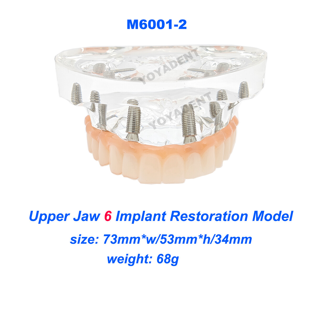 Dental Upper/Lower 4/6 Implants Demo Implant Teeth Model Restoration Overdenture