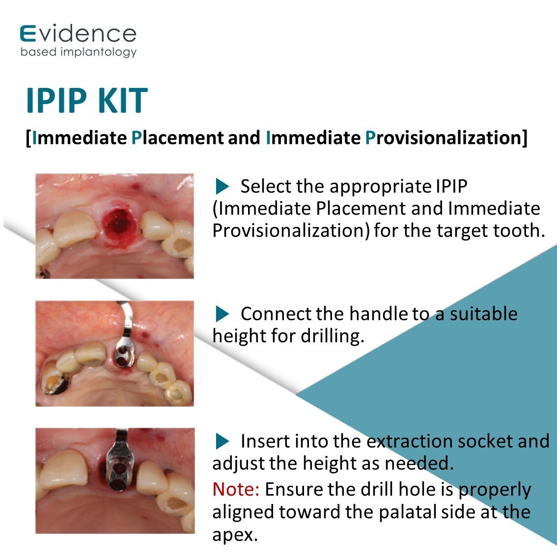 Evidence Implant IPIP Kit
