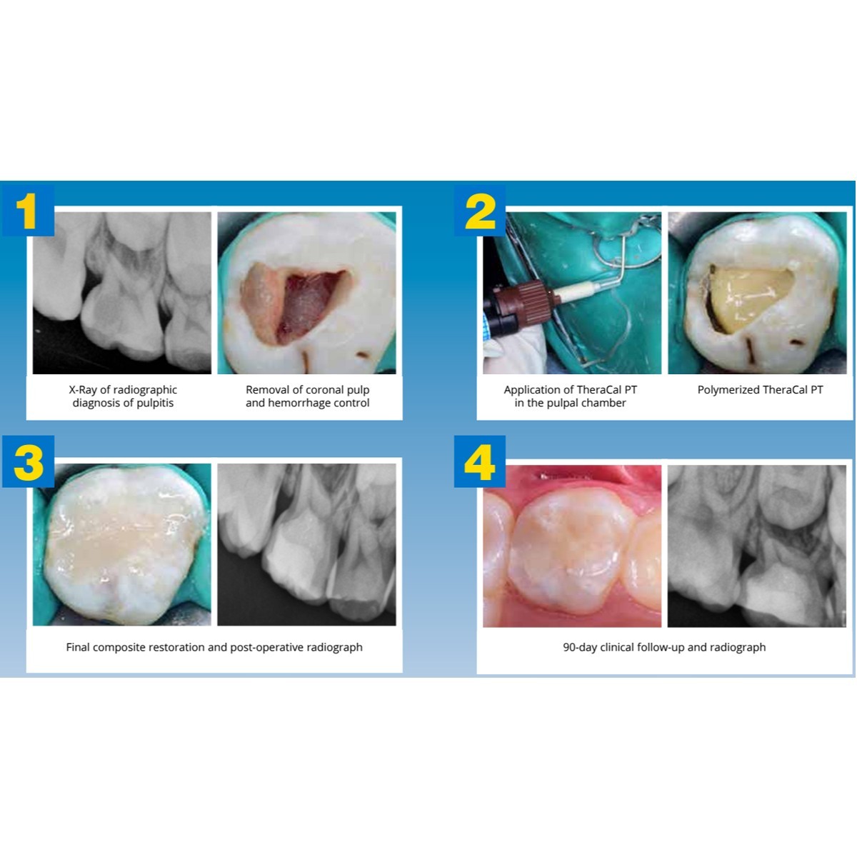 Dental THERACAL PT DC Resin Modified Calcium Silicate Material 4gm Syr & 15 Tips